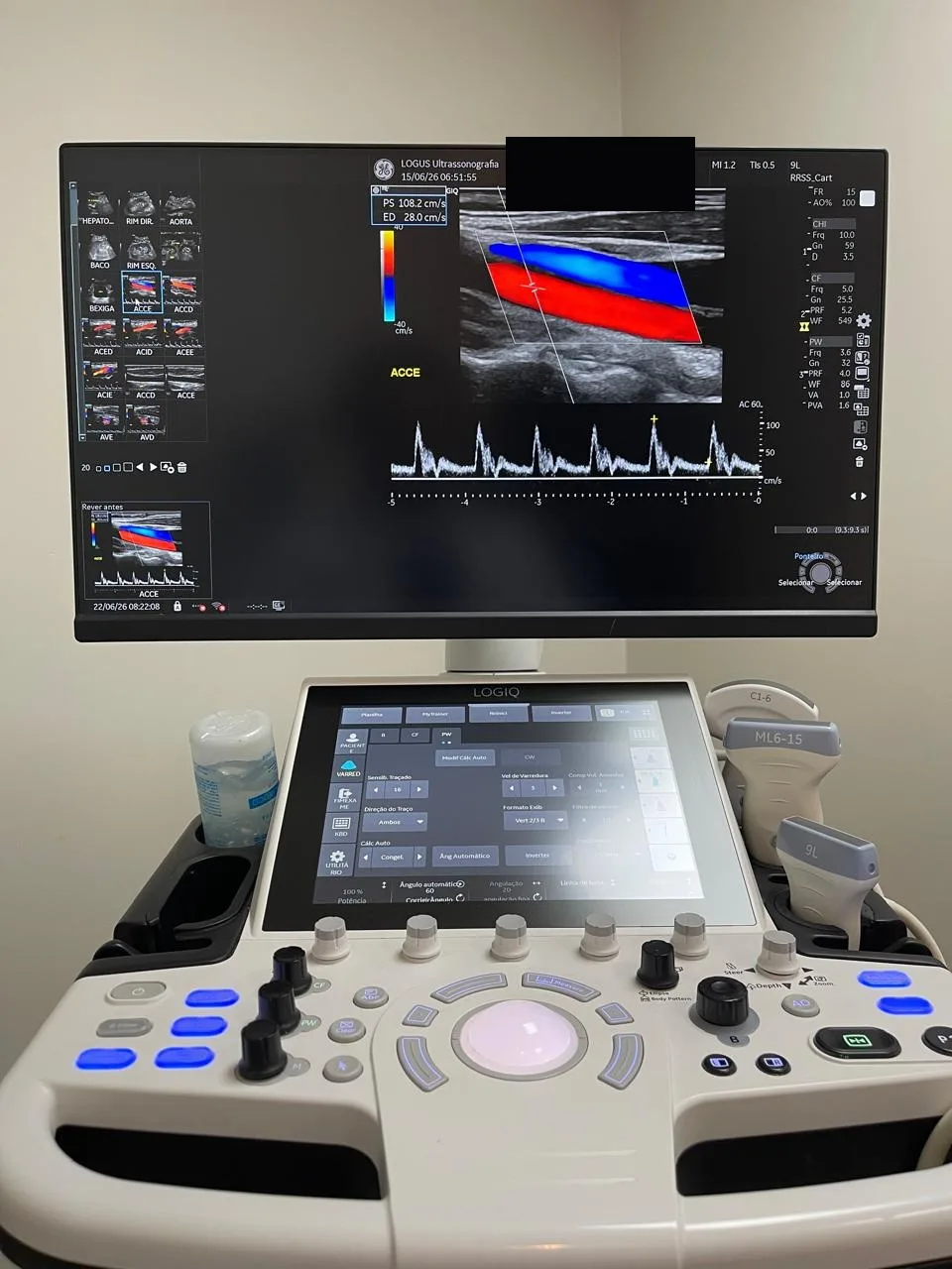 Aparelho de ultrassom GE LOGIQ exibindo um Doppler colorido de carótida na LOGUS