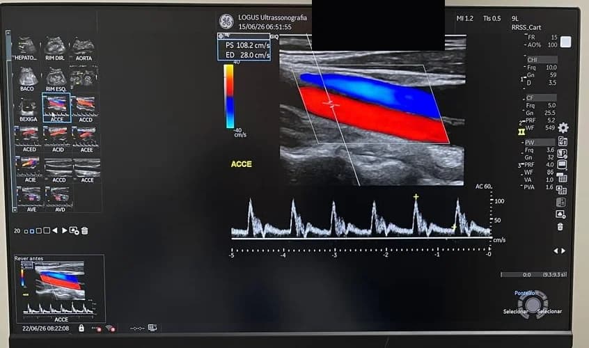 Doppler Vascular · Duplex Scan