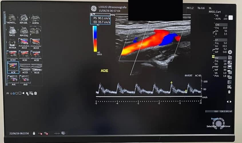 Doppler colorido de carótida interna com mapa de fluxo em mosaico