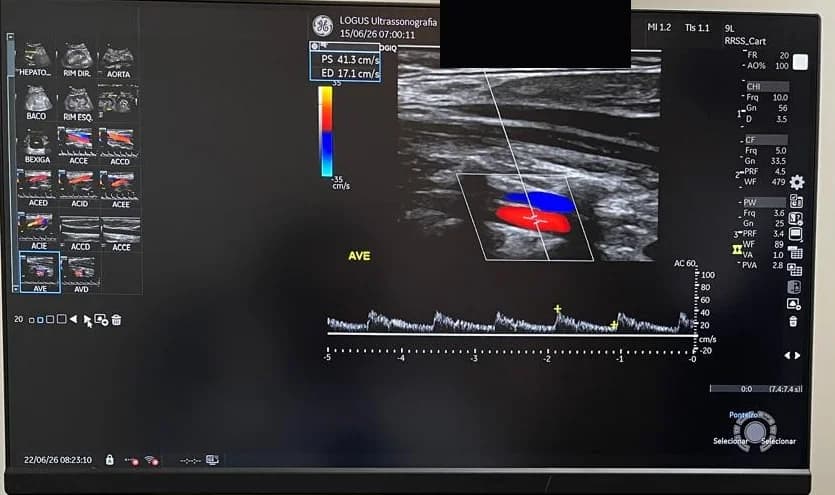Artéria vertebral avaliada com Doppler colorido e espectro de velocidades
