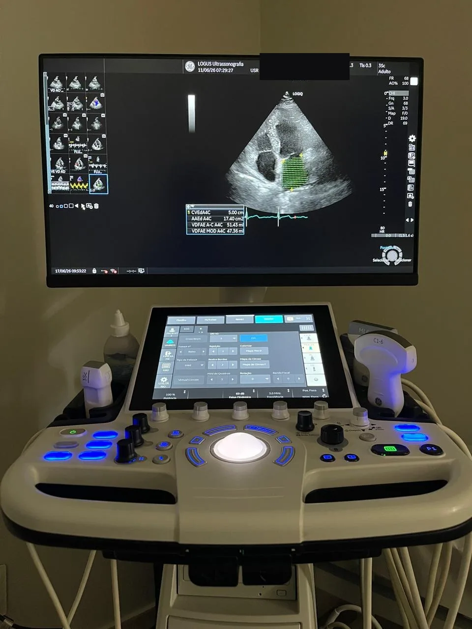 Aparelho de ultrassom GE LOGIQ durante um ecocardiograma com strain na LOGUS
