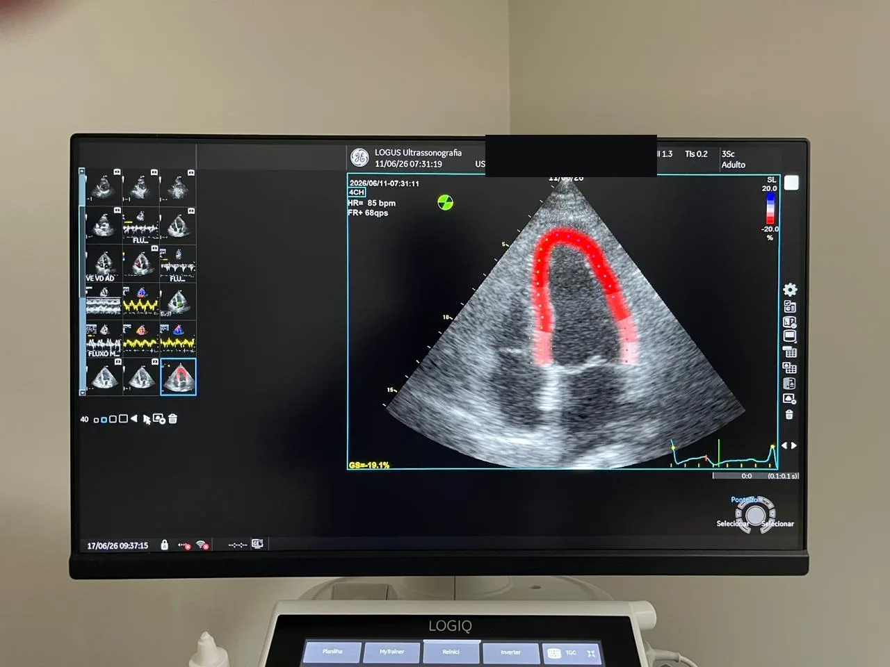 Speckle tracking: contorno do ventrículo esquerdo acompanhado pelo software