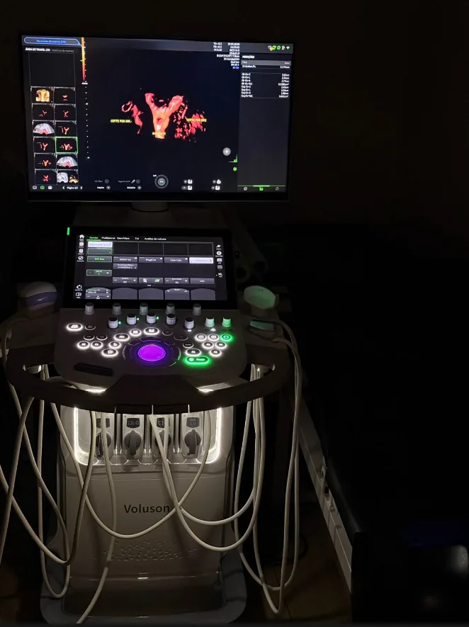 Ultrassom GE Voluson de alta resolução utilizado no HyCoSy na LOGUS