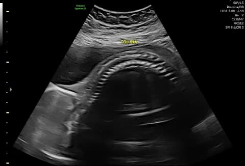 Coluna vertebral fetal avaliada no ultrassom morfológico