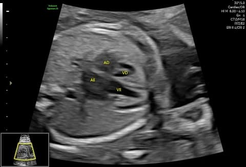 Coração fetal em corte de quatro câmaras no ultrassom morfológico
