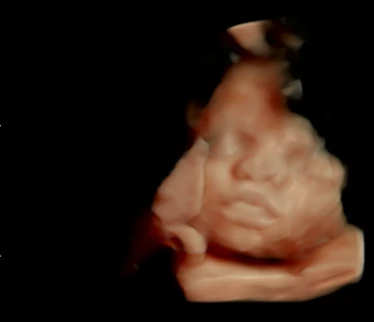 Rostinho de bebê em ultrassom 4D realizado na LOGUS