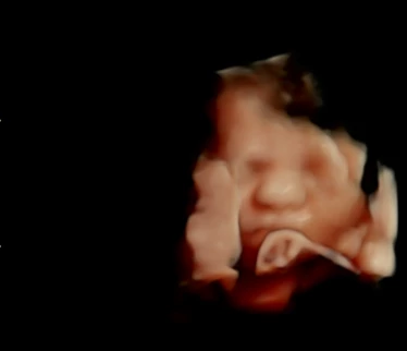 Bebê com a mãozinha junto ao rosto em ultrassom 4D na LOGUS